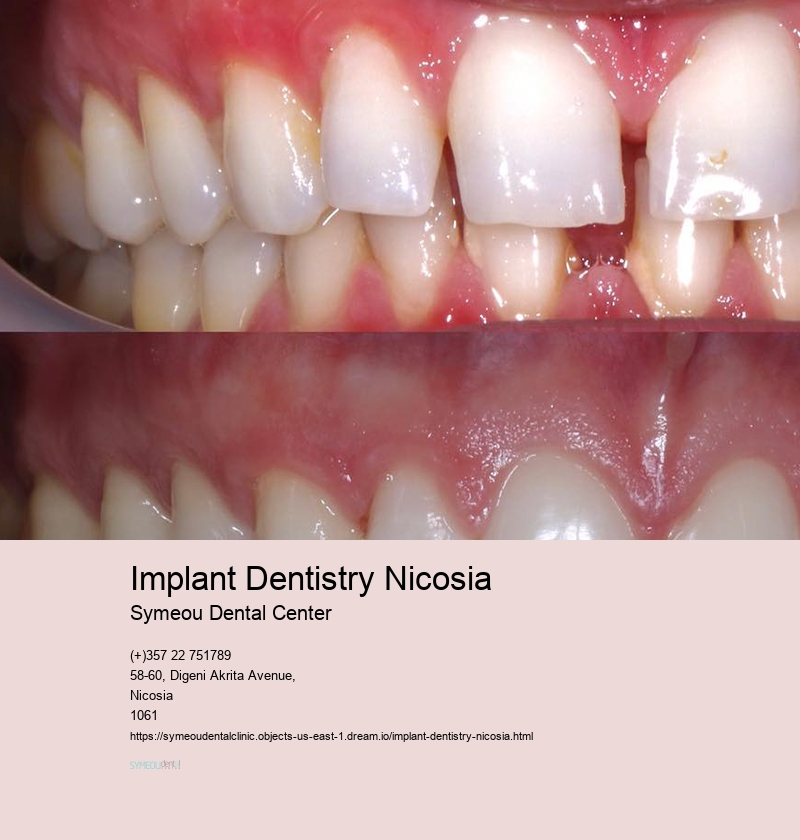 Implant Dentistry Nicosia